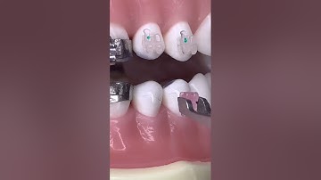 Niềng răng thẩm mỹ bằng mắc cài sứ  #dentist #niềngrăng#niengrang #nhakhoa