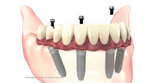 All-on-4 procedure animation.