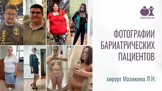 Фото бариатрических пациентов. Хирург Лилия Мазикина