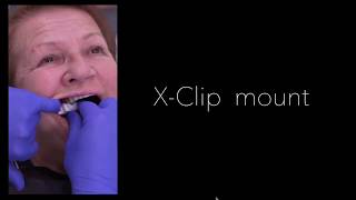 X-Guide All-On-4 Immediate Implantation Eng