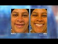 Replacing Missing Teeth with Dental Implants with Brooklyn, NY Dentist Dr. Moise Nawlo