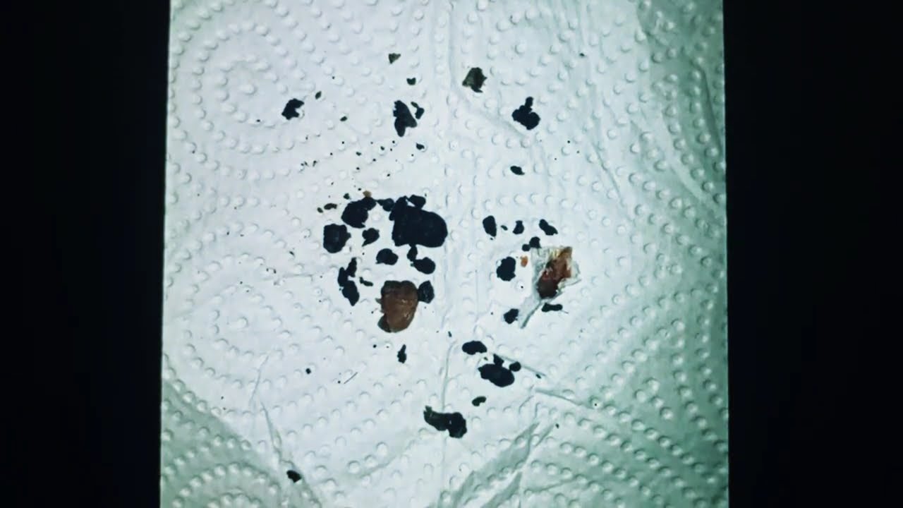 "ASMR Ear Wax Cleaning 👂 | Deep Relaxing Ear Care & Satisfying Sounds"