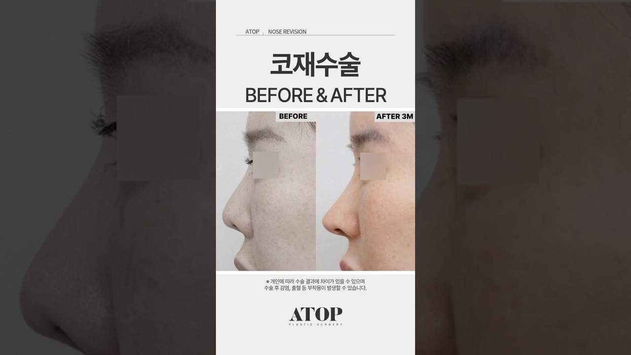 [Эйтоп Гоо Сайхны Мэс Заслын Эмнэлэг] Хамрын давтан мэс засал хийлгэх шалтгаанууд #ХамрынГооСайхныМэсЗасалСайнХийдэгГазар #ХамрынДавтанМэсЗасал #ЭйтопГооСайхныМэсЗаслынЭмнэлэг