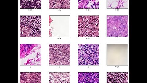 How I Detected Cancer Metastasis Using AI