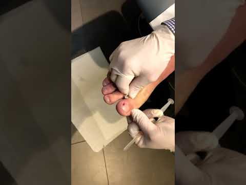 nail surgery - Aldershot & Farnahm Chiropody & Podiatry