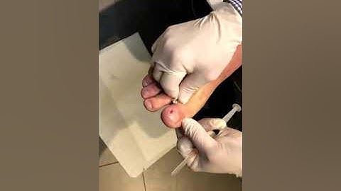 Local Anaesthetic for Ingrown Toenails - Digital Block
