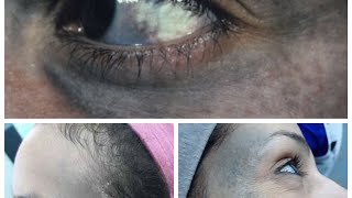 وحمة اوتا Nevus of ota شكلها اية ؟؟؟ويا تري لها علاج ؟؟؟يلا نستفيد ونعرف مع بعض 