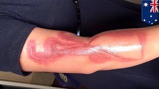 Pregnant mother suffers second degree burn after falling asleep on her iPhone 7 - TomoNews