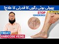 Varicose Veins Ka Qudrati Ilaj - Treat Varicose (Spider) Veins Naturally - Urdu/Hindi - Dr. Ibrahim