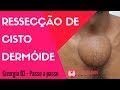 Cisto Dermóide Volumoso - Cirurgia #03# Passo a passo | Dr Jônatas Catunda