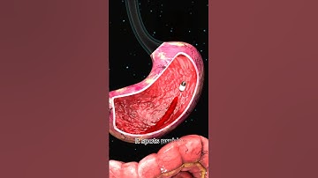 Hoe artsen capsule-endoscopie gebruiken