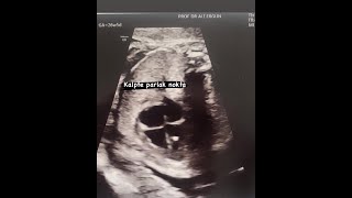 BEBEĞİN BEYNİNDE KİST, KALPTE PARLAKLIK screenshot 4