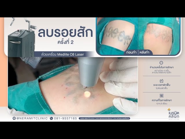 ลบรอยสัก EP.55/ลบรอยสัก ครั้งที่2 @หมอปุ๊ Neramit Clinic