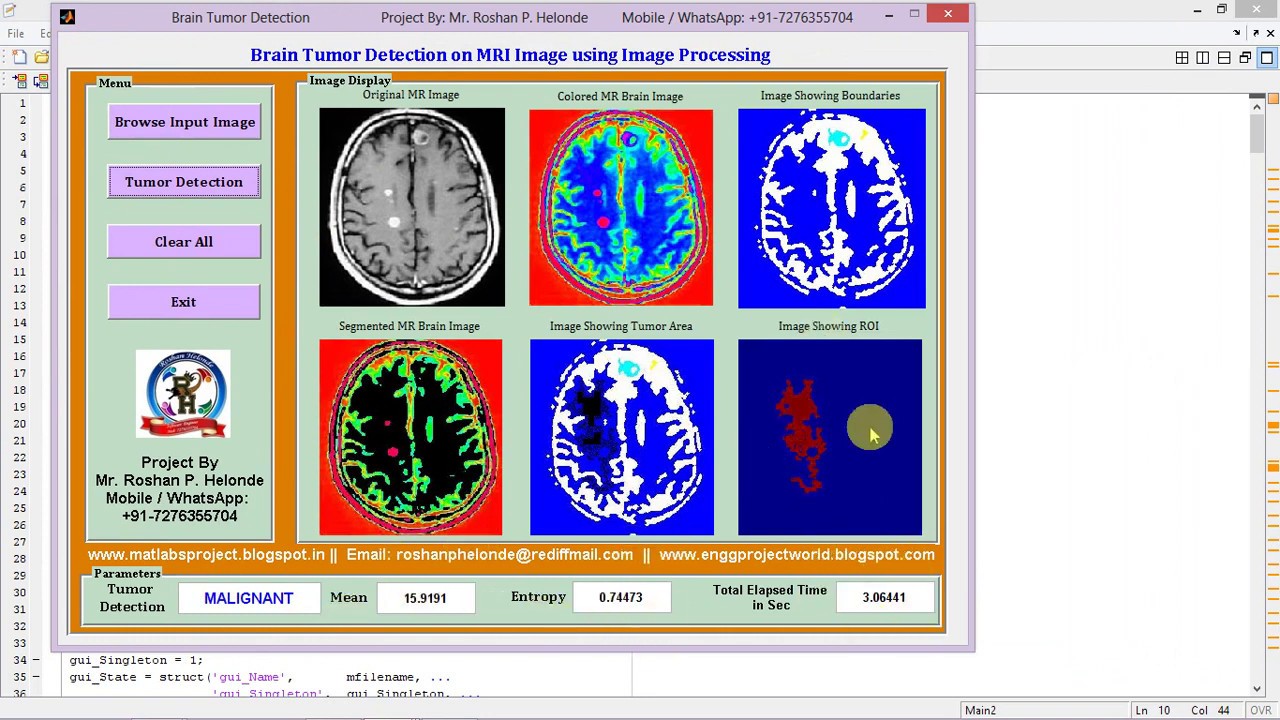 Brain Tumor Detection using matlab - YouTube