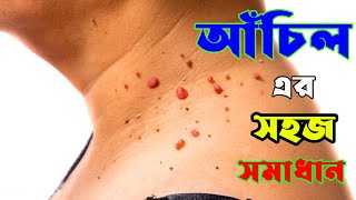 Home treatment for warts | Wart and its Easy Treatment | আঁচিল দূর করার উপায় |  HELLO DOCTOR