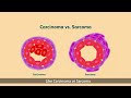 Importance of Early Detection of Sarcoma | Dr. Prateek Hegde | Orthopaedic Oncology | SBS Health