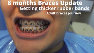 8 Months Braces update | Getting thicker rubber bands and black elastics #braceswithdolly