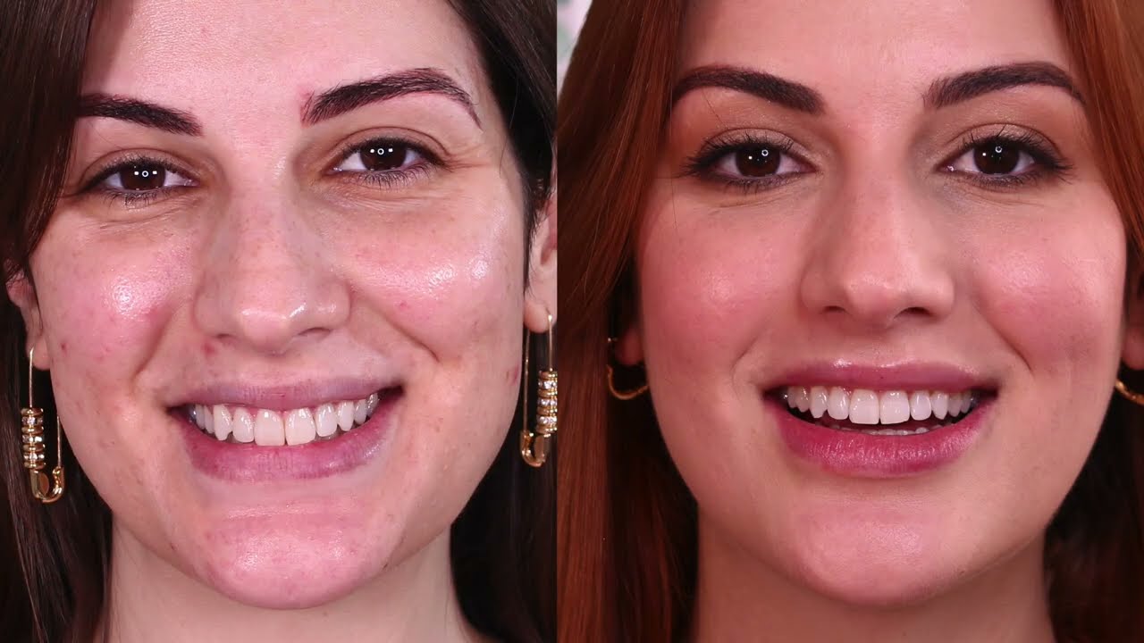 APARELHO INVISÍVEL: Minha experiência + dicas após 5 meses com o aparelho transparente Sousmile