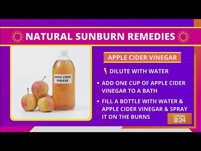 3 natural sunburn remedies 