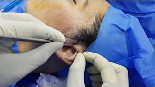 Mini Face Liftshort Scar Face Liftr Lift By Dr Amin Yousaf Lahore Plastic Surgeon Stan