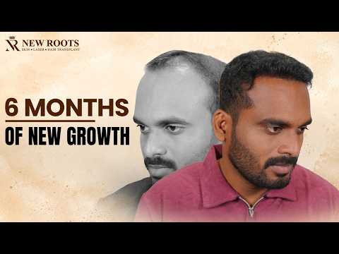 6 Months of Growth… And He’s Loving It! 😍 | Grade 5 Baldness | Hair Transplant in Pune | Best Cost