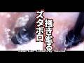 【超爽快★黒三連円盤】ズタボロ外耳道を容赦なく掻き毟って綺麗にしていく耳掃除/爆裂イヤースコープ/引掻き音/音フェチ/マッサージ/痒み解消/睡眠導入【本物耳かきエンターテインメントASMR】