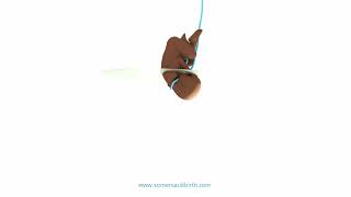 Animation to show the Somersault method to resolve a tight nuchal cord