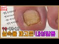 무좀때문에 살속을 파고든 내성발톱 ingrown toenail / ingrowing nail - 레푸스 남양주호평점 Refuss