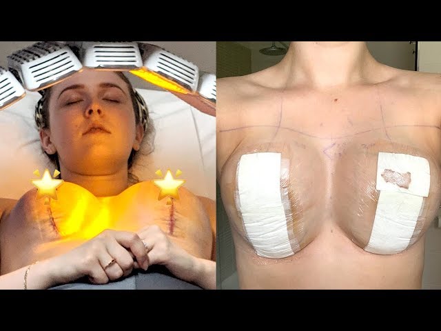 BREAST LIFT RECOVERY WEEK 1  Mastopexy Surgery 