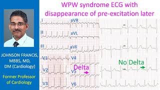 WPW syndrome ECG with disappearance of pre-excitation later screenshot 1