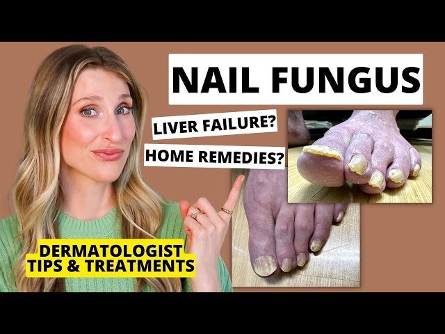 How to get rid of nail fungus - Quora