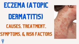 Eczema (Atopic Dermatitis) Causes, Treatment, Symptoms