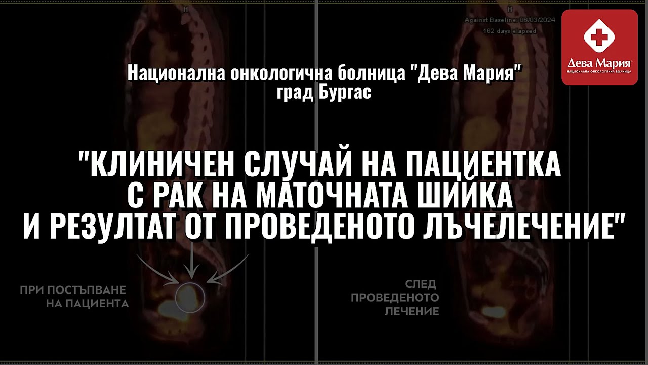 Лъчетерапия при пациентки с рак на маточната шийка - резултати от проведено лъчелечение