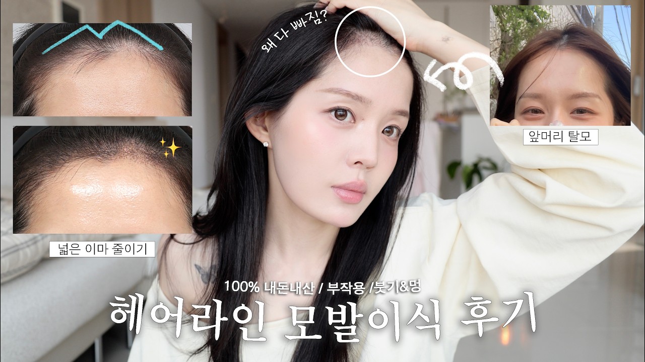 M자이마 스트레스 탈출💉💆🏻‍♀️ 헤어라인 모발이식 후기 ㅣ넓은 이마 얼굴형 ㅣ부작용🩸ㅣ내돈내산 ㅣ일주일 회복과정ㅣ한달 총 정리