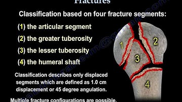 Proximal Humerus Fractures classification - Everything You Need To Know - Dr. Nabil Ebraheim