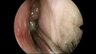 Removal of Nasal Polyps with a Microdebrider