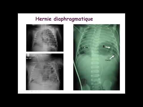 Vidéo: Hernie Diaphragmatique - Symptômes, Traitement Chez Les Nouveau-nés Et Les Enfants