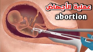 شاهد عملية الأجهاض في الحقيقة_abortion