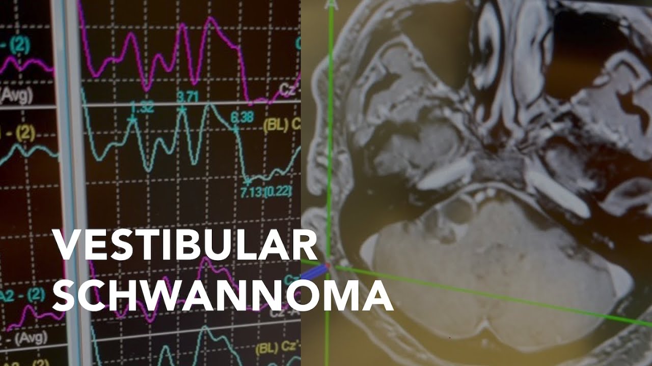 Vestibular Schwannoma/Acoustic Neuroma YouTube