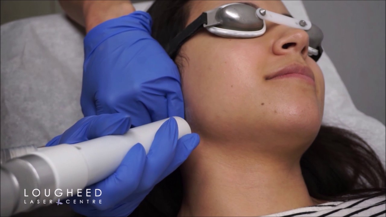 Laser Hair Removal With The Softlight Laser YouTube what-is-soft-washing-spray-away-softwash