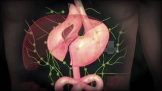 위,위암수술, 위암림프절전이와 치료법,위전절제술,cancer of stomach,Total gastrectomy