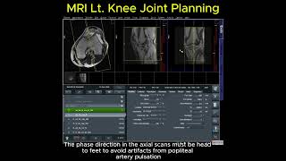 MRI Knee Joint Planning  #mri  #ctscan  #radiology #radiographer graphy  #medicalimaging #radtech