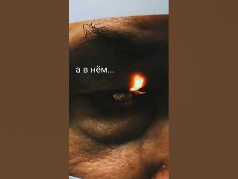 Впечатляющий симптом "золотого дождя" #зрение #стекловидноетело #мушки ...