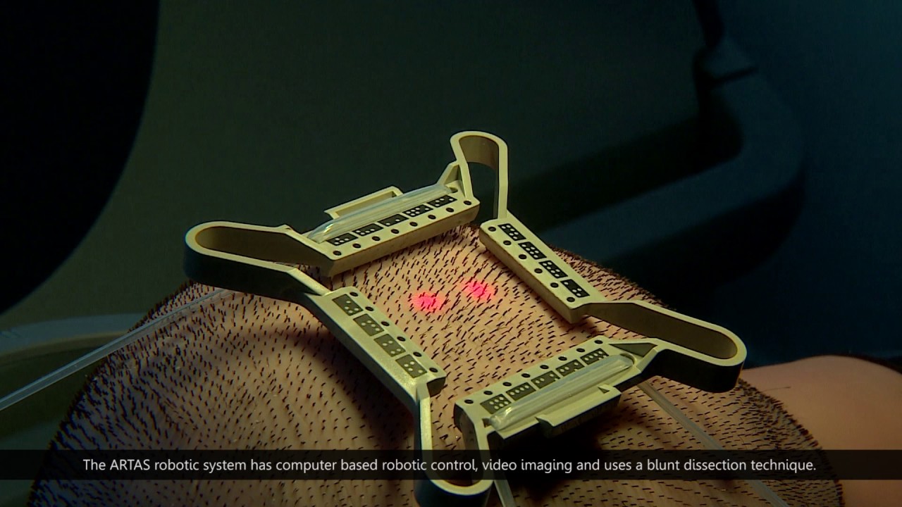 dr Turowski- przeszczep włosów metodą FUE Artas