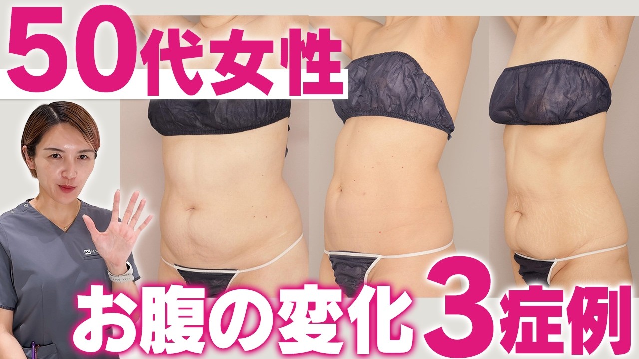 50代で脂肪吸引は皮膚たるむ？症例写真でBMI・体型が違う3人のお腹の変化を解説！｜脂肪吸引の母#270