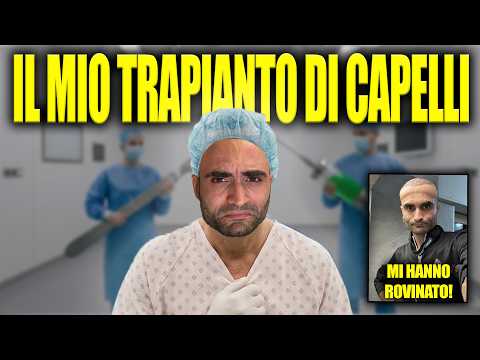 Video HO FATTO IL TRAPIANTO DI CAPELLI IN TURCHIA - E' DAVVERO PERICOLOSO?!