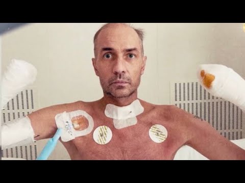 СРАЗУ ПОСЛЕ АМПУТАЦИИ! Роман Костомаров Впервые Снял Бинты На Публике