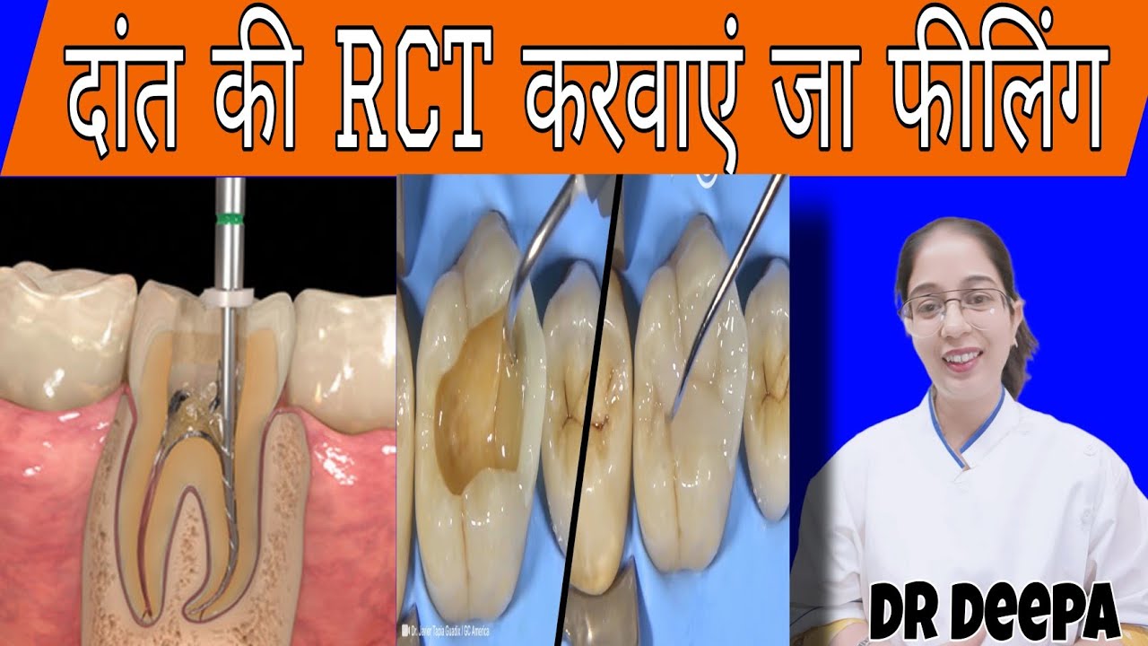 RCT ya FIlling which one better? - YouTube