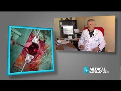 Video: Chirurgia Laser Della Schiena: Vantaggi, Svantaggi, Efficacia E Altro