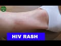 How do I know if I have a HIV rash | hiv/aids